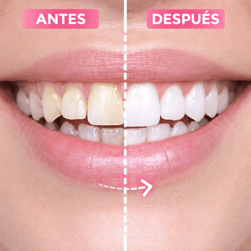 Sonic Smile: Removedor de Cálculo dental